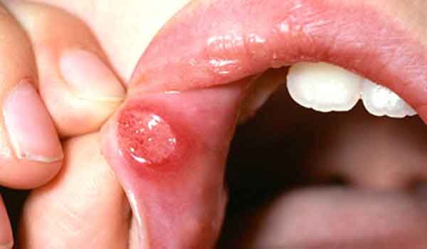 Water Blister Inside Mouth 81